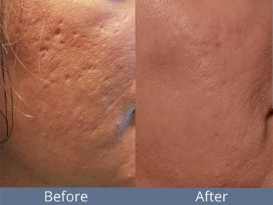 Before and after Morpheus8 skin tightening results at ID Clinic Bangkok, smoother facial skin