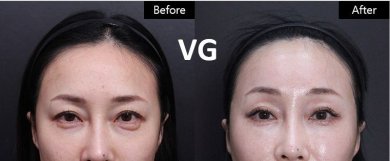 Vorher-nachher-Ergebnis Brauenlifting bei VG Plastic Surgery, sichtbare Stirn- und Augenverbesserung