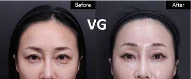 Vorher-nachher-Ergebnis Brauenlifting bei VG Plastic Surgery, sichtbare Stirn- und Augenverbesserung