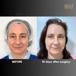 Before and after upper eyelid surgery results at ID Clinic Bangkok, 10 days post-procedure