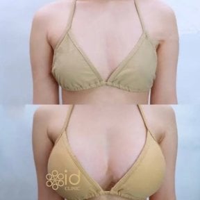 Résultats avant et après augmentation mammaire à ID Clinic Bangkok, volume accru