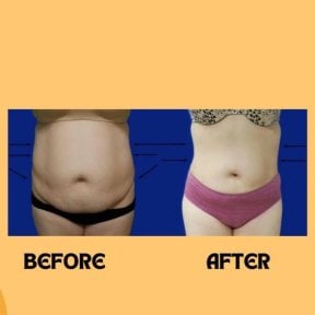 Before and after liposuction results at ID Clinic Bangkok, visible abdominal contour improvement