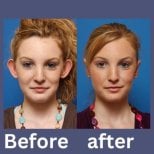 Resultados de otoplastia antes y después en ID Clinic Bangkok, orejas con aspecto natural