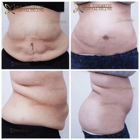 Before and after tummy tuck results at Asia Cosmetic Hospital, improved abdominal contour