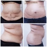 Before and after tummy tuck results at Asia Cosmetic Hospital, improved abdominal contour