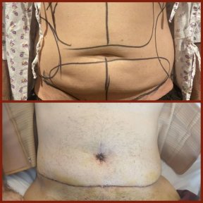 Resultados de abdominoplastia antes y después en DGB Clinic – mejor contorno abdominal masculino