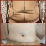 Resultados de abdominoplastia antes y después en DGB Clinic – mejor contorno abdominal masculino