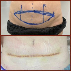 Resultados de abdominoplastia antes y después en DGB Clinic – mejora del contorno abdominal