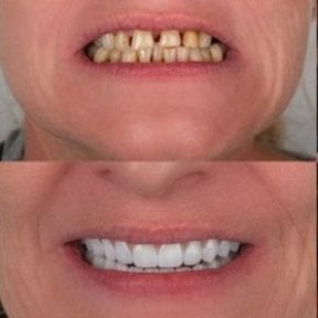 Vorher-nachher-Ergebnis All-on-4-Implantate bei Dentfix Turkey Clinic, verbesserte Lächeln