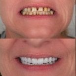 Vorher-nachher-Ergebnis All-on-4-Implantate bei Dentfix Turkey Clinic, verbesserte Lächeln