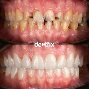 Before and after zirconia crown results at Dentfix Turkey Clinic – smile restoration