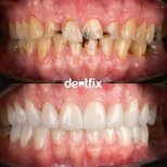 Before and after zirconia crown results at Dentfix Turkey Clinic – smile restoration