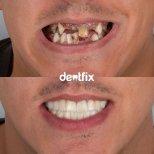 Before and after zirconia crown results at Dentfix Turkey Clinic, smile restoration achieved