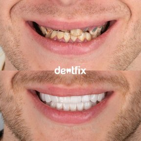 Before and after zirconia crown results at Dentfix Turkey Clinic, smile transformation