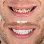 Before and after zirconia crown results at Dentfix Turkey Clinic, smile transformation