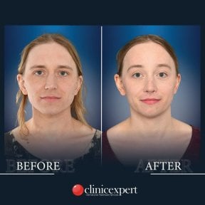 Before and after brow lift results at CE International Hospital, visible forehead lift improvement