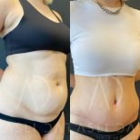 Vorher-nachher-Ergebnis BodyTite-Körperkonturierung bei Liv Hospital Ulus, Bauchfettreduktion
