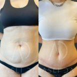 Vorher-nachher-Ergebnis BodyTite-Körperkonturierung am Bauch in Liv Hospital Ulus