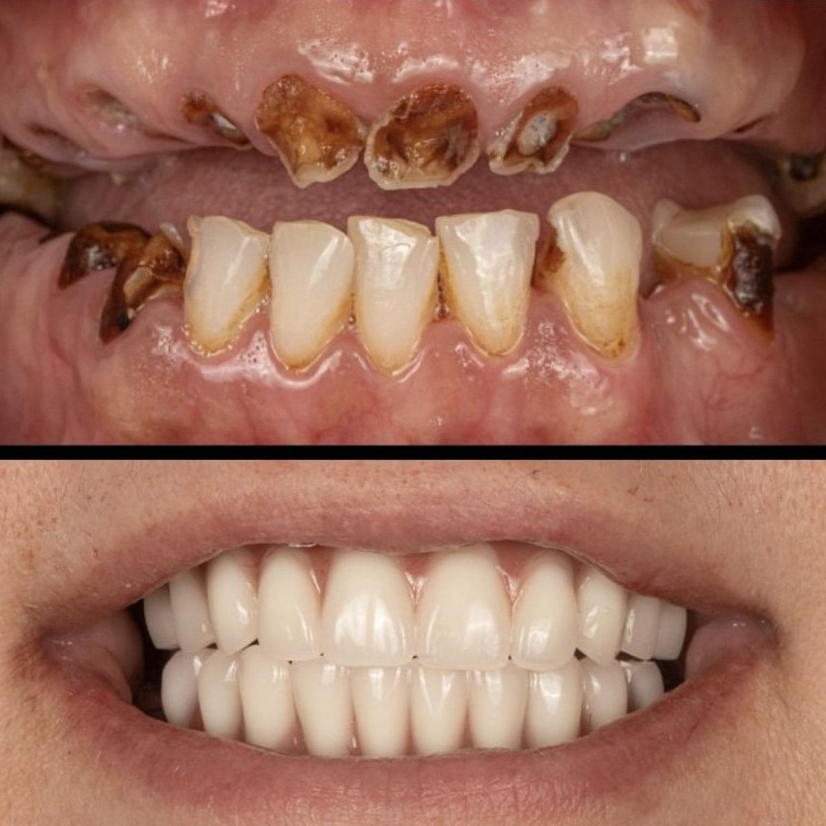 Resultados antes y después de implantes dentales en HALDENT Dental Clinic – sonrisa restaurada