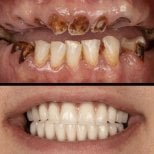 Результаты до и после имплантации зубов в HALDENT Dental Clinic – полное восстановление улыбки