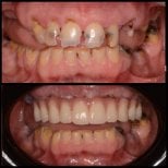 Результаты до и после имплантации зубов в HALDENT Dental Clinic, восстановленная улыбка