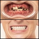 Результаты до и после имплантации зубов в HALDENT Dental Clinic – восстановление улыбки