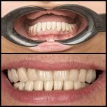 Результаты до и после имплантации зубов в HALDENT Dental Clinic, улучшение улыбки