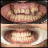 Результаты до и после имплантации зубов в HALDENT Dental Clinic, восстановление улыбки