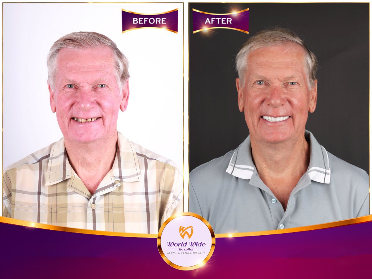 Resultados de implantes dentales antes y después en World Wide Hospital: sonrisa restaurada