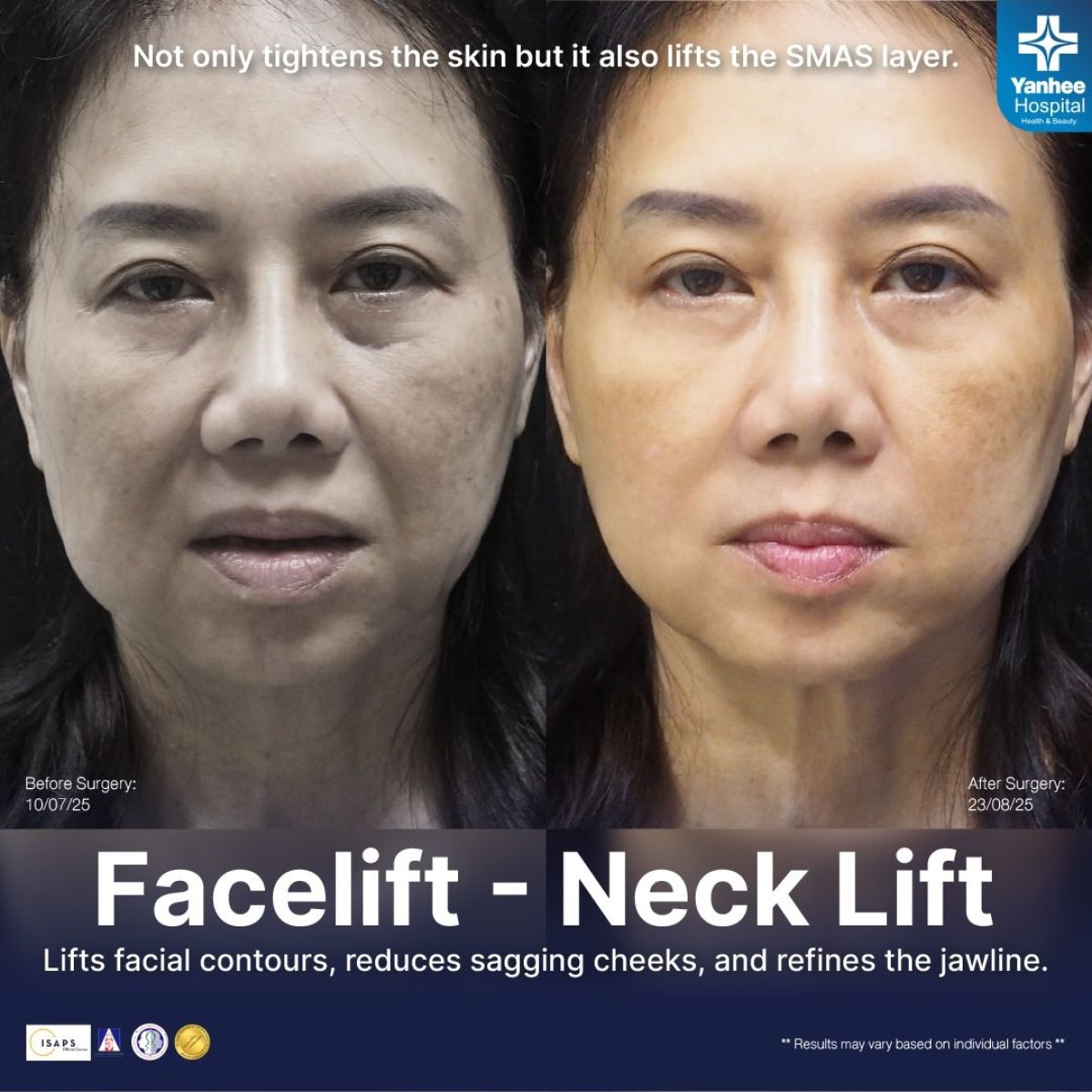 Vorher-nachher-Ergebnisse Facelift und Halslift bei Yanhee International Hospital, verbesserte Konturen