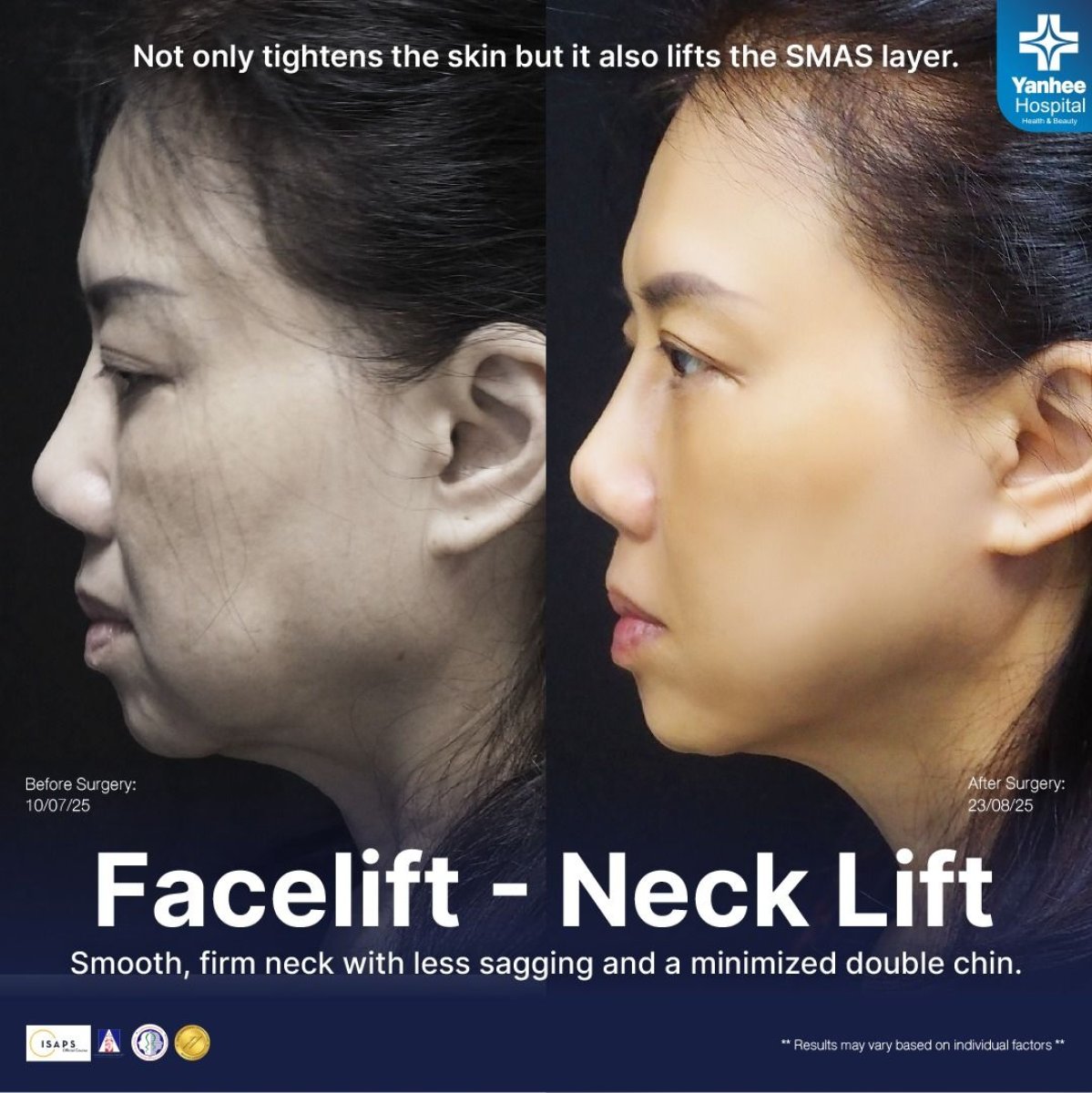 Vorher-nachher-Ergebnis Facelift und Halslifting bei Yanhee International Hospital, straffere Kinnlinie