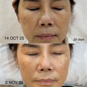 Before and after stem cell rejuvenation therapy result at EDNA Wellness, improved skin tone