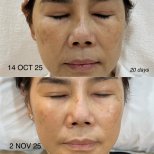 Before and after stem cell rejuvenation therapy result at EDNA Wellness, improved skin tone