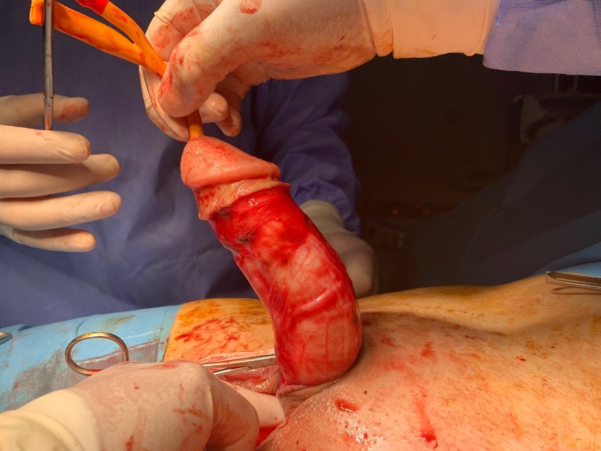 Chirurgie d’implant pénien à la clinique Uroaesthetic, résultat d’une procédure avancée