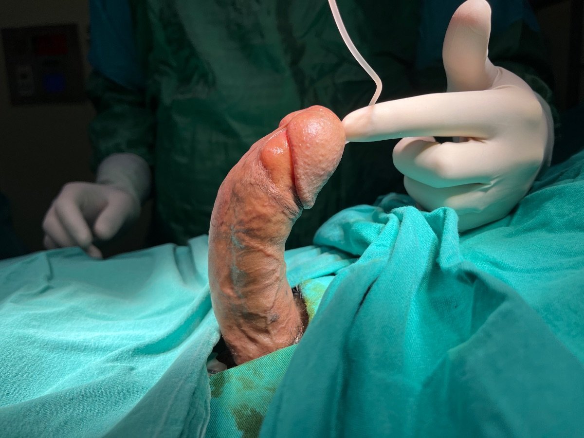 Résultat d’implant pénien à la clinique Uroaesthetic – fonction érectile améliorée