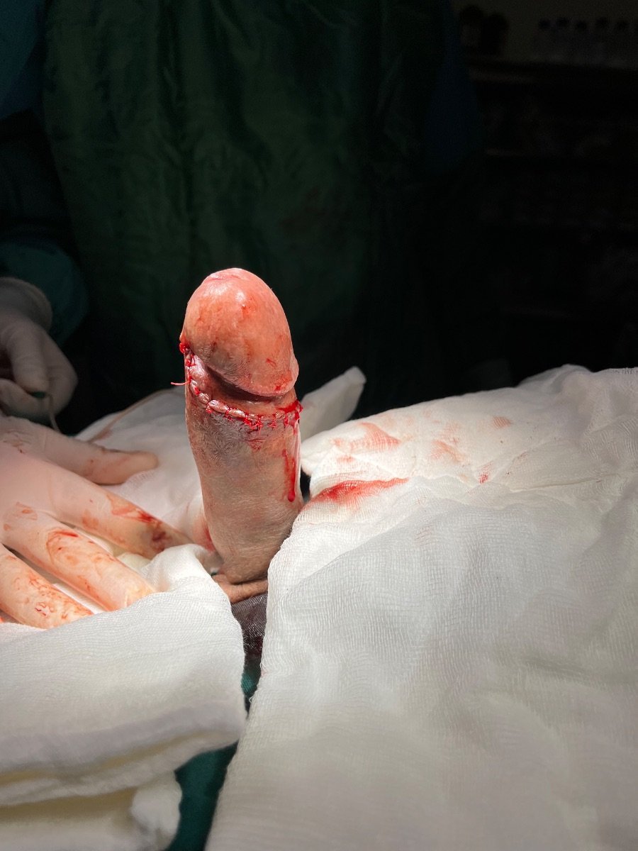 Résultat d’implant pénien à Uroaesthetic, vue peropératoire de la reconstruction pénienne