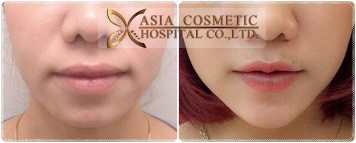 Facelift Vorher-Nachher-Ergebnisse bei Asia Cosmetic Hospital, verbesserte Gesichtskontur