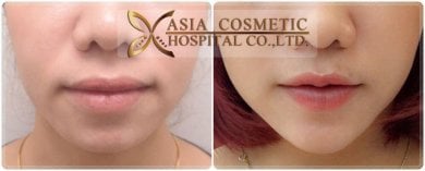 Résultats avant/après lifting du visage à Asia Cosmetic Hospital, amélioration du contour