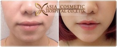 Résultats avant/après lifting du visage à Asia Cosmetic Hospital, amélioration du contour