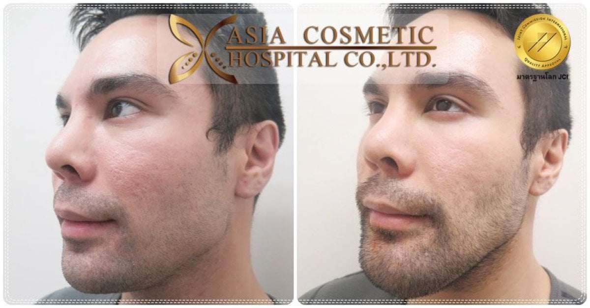 Facelift Vorher-Nachher-Ergebnisse bei Asia Cosmetic Hospital, sichtbare Verjüngung