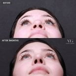 Resultados de rinoplastia antes y después en VG Plastic Surgery, remodelación nasal tras 3 meses