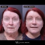 Deep plane facelift before and after results at VG Plastic Surgery, visible facial rejuvenation