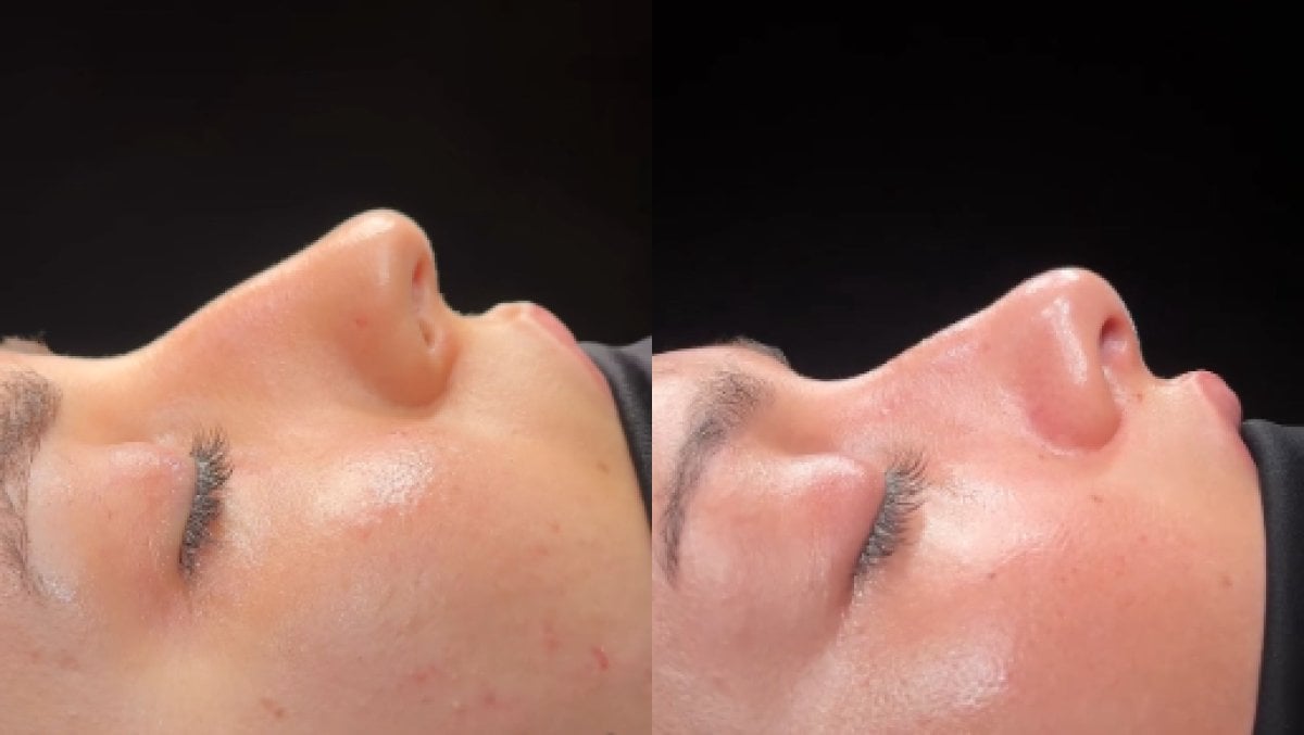 Résultats avant et après rhinoplastie chez Soraca Med, remodelage naturel du nez