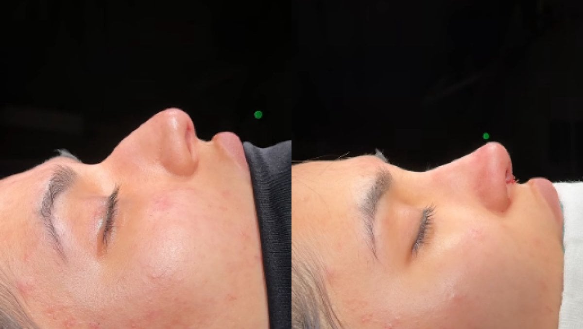 Résultats avant et après rhinoplastie chez Soraca Med, profil et contour du nez améliorés