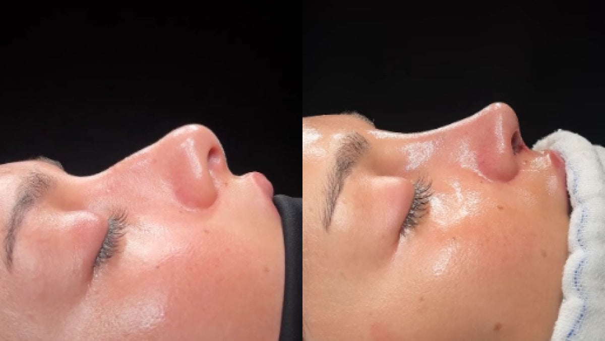 Résultats avant et après rhinoplastie chez Soraca Med, profil nasal naturel