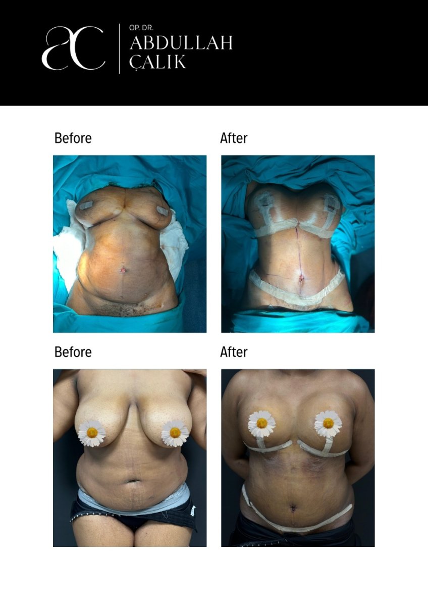 Résultats avant et après abdominoplastie et liposuccion à Soraca Med Istanbul, remodelage corporel