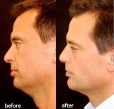 Before and after Deep Plane Facelift results at ID Clinic Bangkok, visible jawline improvement