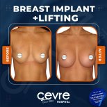 Before and after breast augmentation results at Adem and Havva Medical Center, fuller lifted breasts