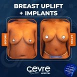 Before and after breast augmentation results at Adem and Havva Medical Center, uplift with implants