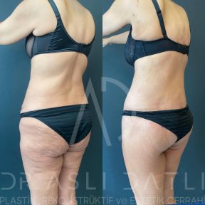 Vorher-nachher-Ergebnis Vaser-Liposuktion bei Liv Hospital Ulus, verbesserte Körperkontur